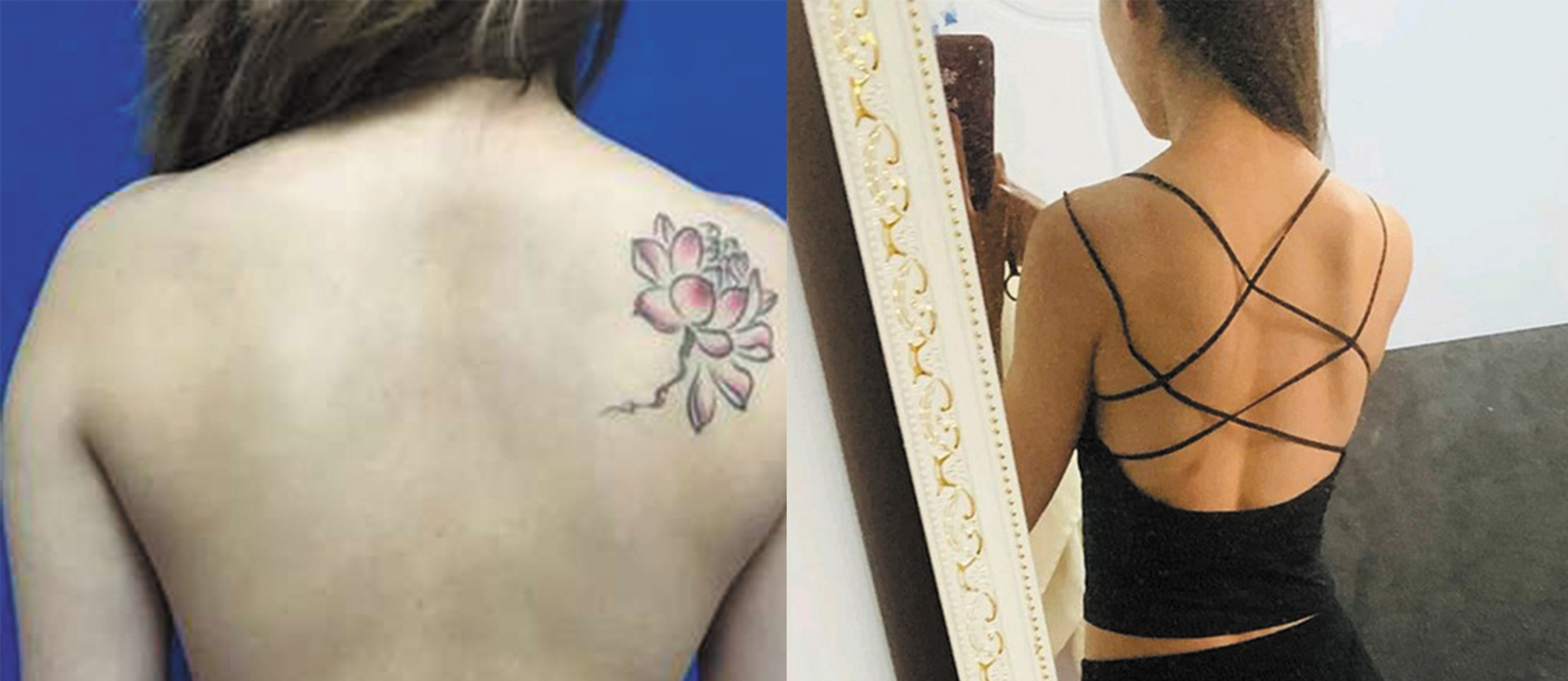 背部吸脂手術(shù)對(duì)比圖2