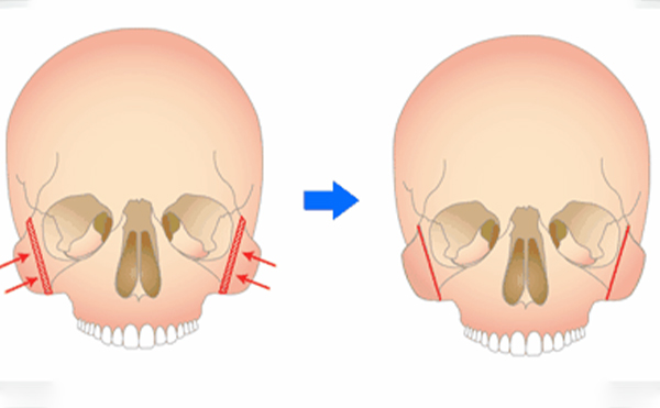 重慶藝星顴骨降低是怎么做的？術(shù)后要注意什么？