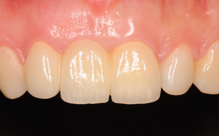 門牙種植牙需要多少錢一顆？