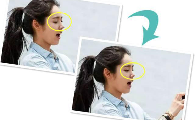 朝天鼻手術需要多少錢？