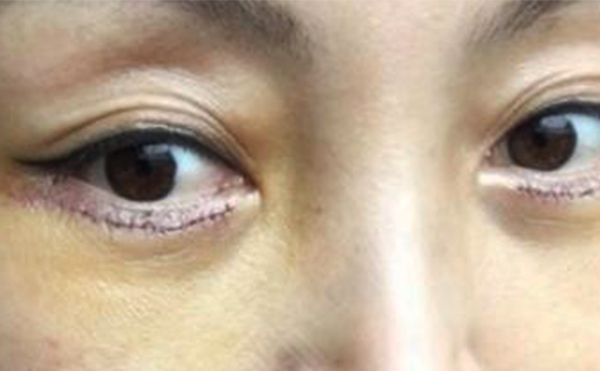 眼袋修復一般多少錢?眼袋修復術后怎么護理?