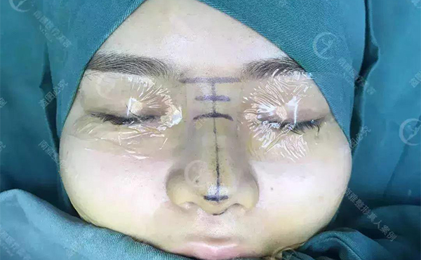 隆鼻術(shù)后多久能看到效果？