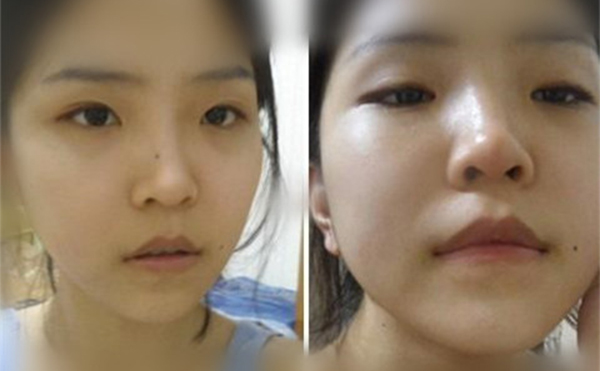 鼻翼缺損修復后和常人一樣嗎？