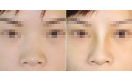 做隆鼻手術(shù)會(huì)留疤嗎?