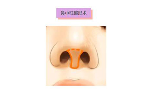 鼻小柱延長術(shù)是什么？鼻小柱延長手術(shù)有什么優(yōu)點(diǎn)