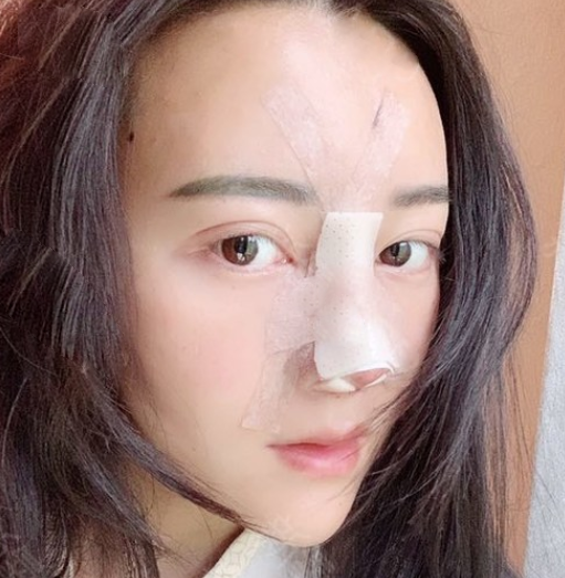 金輝醫(yī)生鼻修復(fù)案例：