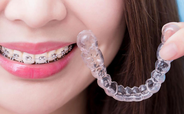 隱形牙套價格多少錢？