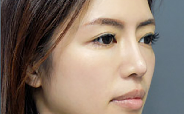 嘉興藝星整形：隆鼻失敗九大表現(xiàn)，快看看你有沒有