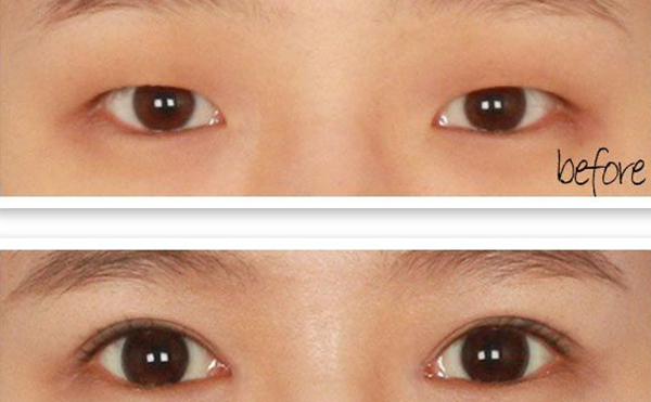 單眼皮可以只開眼角嗎?效果怎么樣?