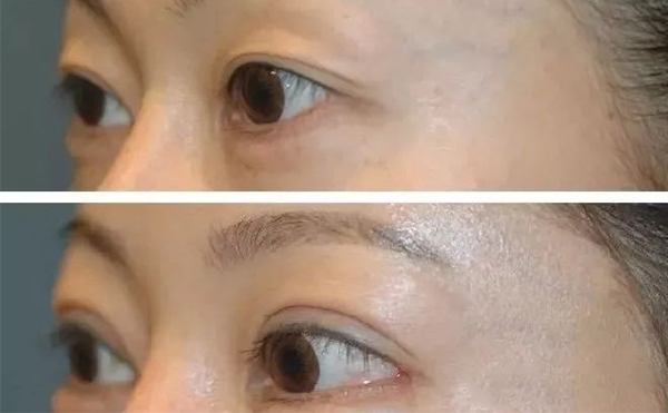 開外眼角需要多久恢復(fù)？