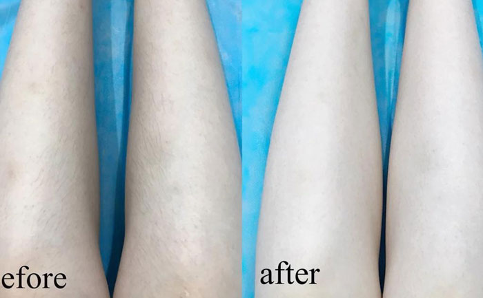 激光脫毛能永久脫毛嗎？