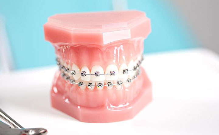 牙齒正畸費(fèi)用一般多少？