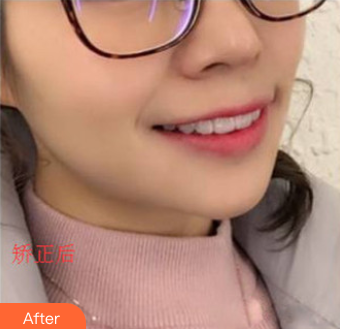 做牙齒矯正之后