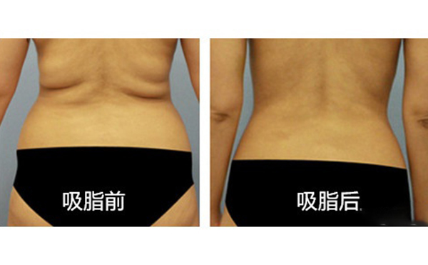 腹部吸脂需要多久恢復(fù)？