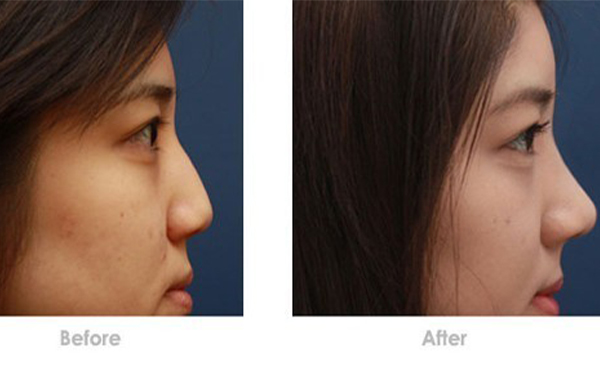 假體隆鼻取出來(lái)鼻子會(huì)變形嗎?