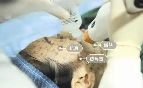 牙齒矯正期間是不能做熱瑪吉嗎？