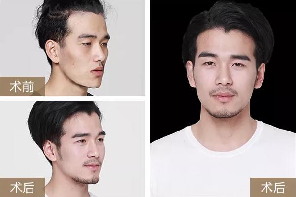 北京熙朵微針植發(fā)案例