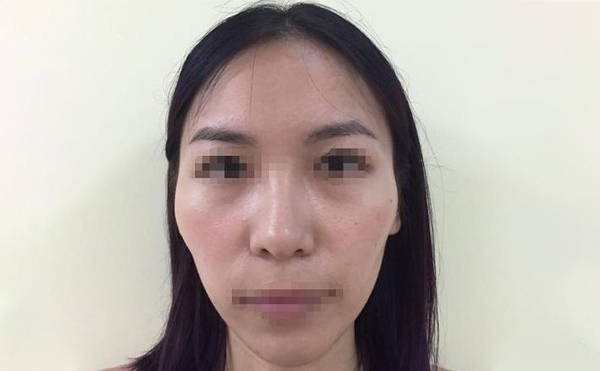 顴骨降低手術(shù)疼不疼？