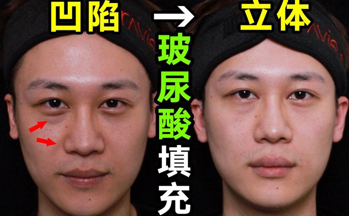 淚溝填充用什么方法最好？淚溝填充手術(shù)大約多少錢(qián)？