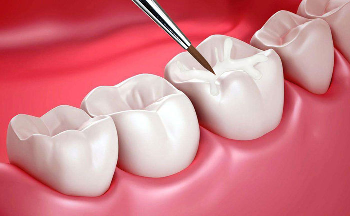 貴金屬烤瓷牙有哪些？貴金屬烤瓷牙的種類