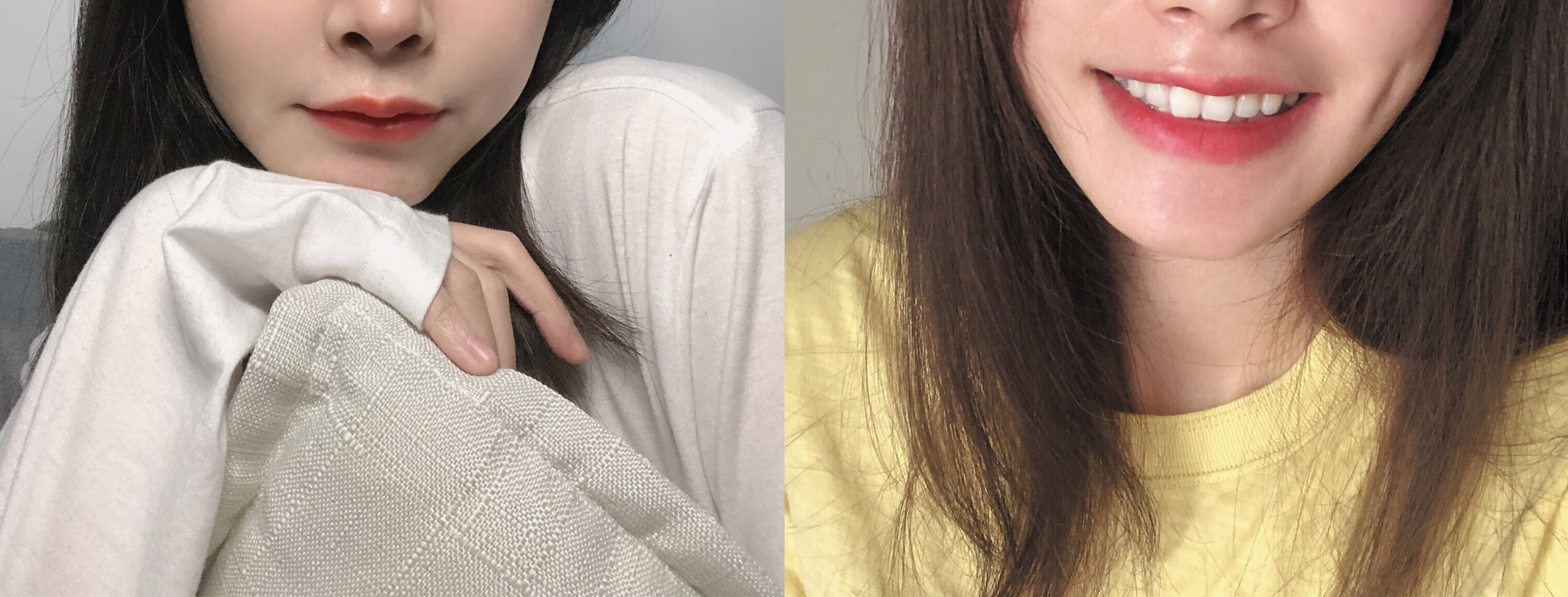 金窩銀窩不如小酒窩~酒窩再造術(shù)，甜美少女?dāng)啬猩衿鳎? data-mce-src=