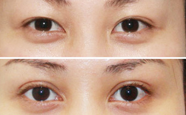 內雙做雙眼皮是什么價格？效果怎么樣？