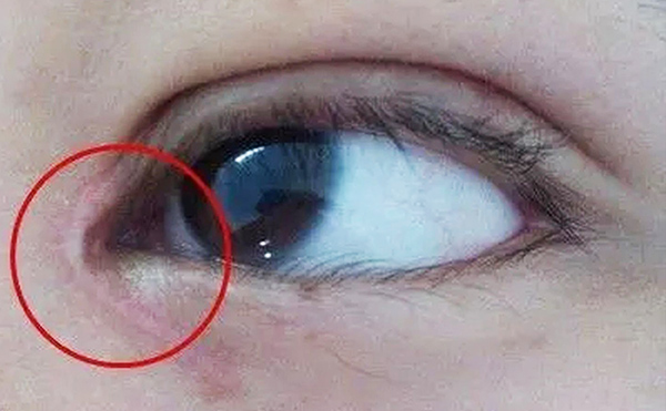 內(nèi)眼角修復(fù)難不難？哪些情況需要修復(fù)?