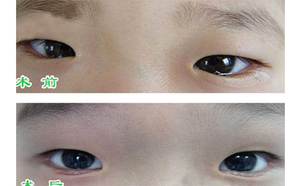 小孩倒睫毛有什么癥狀?小孩倒睫怎么辦?