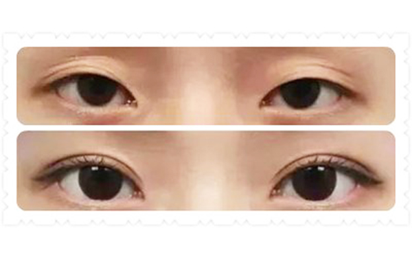 韓式三點(diǎn)雙眼皮價(jià)格是多少?術(shù)后為什么變成多眼皮?