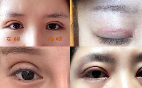雙眼皮術(shù)后為什么不自然?怎樣避免肉條感?