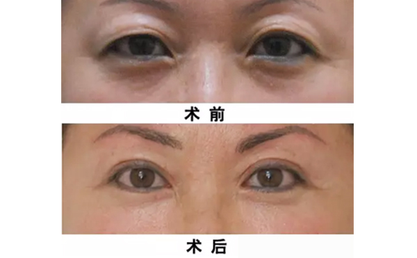 三角眼和上瞼下垂有什么區(qū)別?三角眼割雙眼皮效果怎樣?