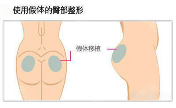假體豐臀多少錢？假體豐臀效果是永久的嗎？