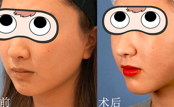 部吸脂有什么優(yōu)勢?術后臉下垂是怎么回事?