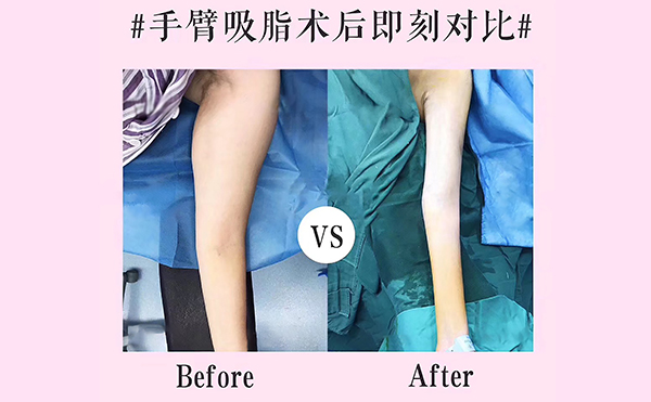 手臂吸脂會反彈嗎？
