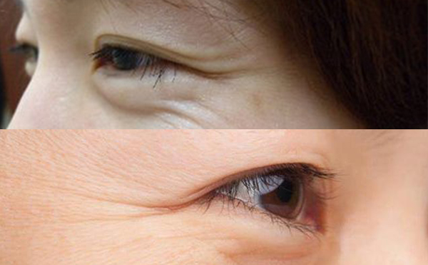 魚尾紋有哪幾種類型？