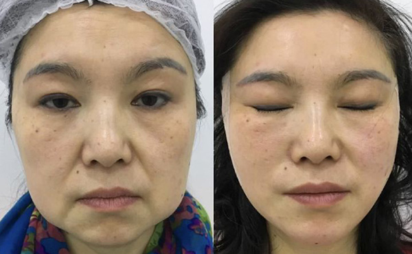 超聲刀適合哪些人群？