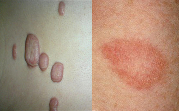 激光去頸紋有并發(fā)癥嗎？