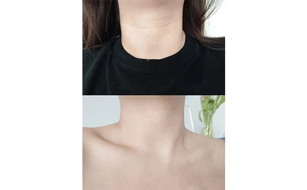 超聲刀去頸紋一年可以做幾次？