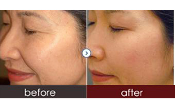 水光針有副作用嗎？