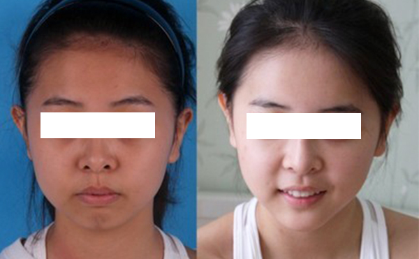 激光美白有什么優(yōu)缺點(diǎn)？