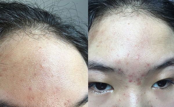 哪些人不適合做冰點(diǎn)面部脫毛？