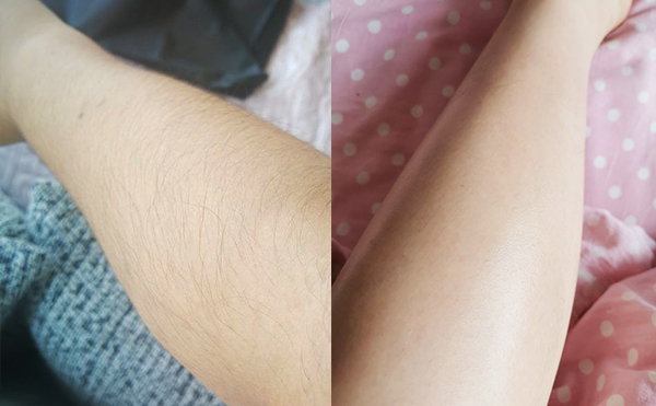 影響激光脫毛效果的因素有哪些？