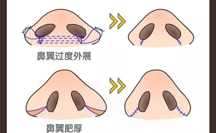 鼻頭肥大怎么改善？鼻頭肥大矯正術(shù)多少錢？