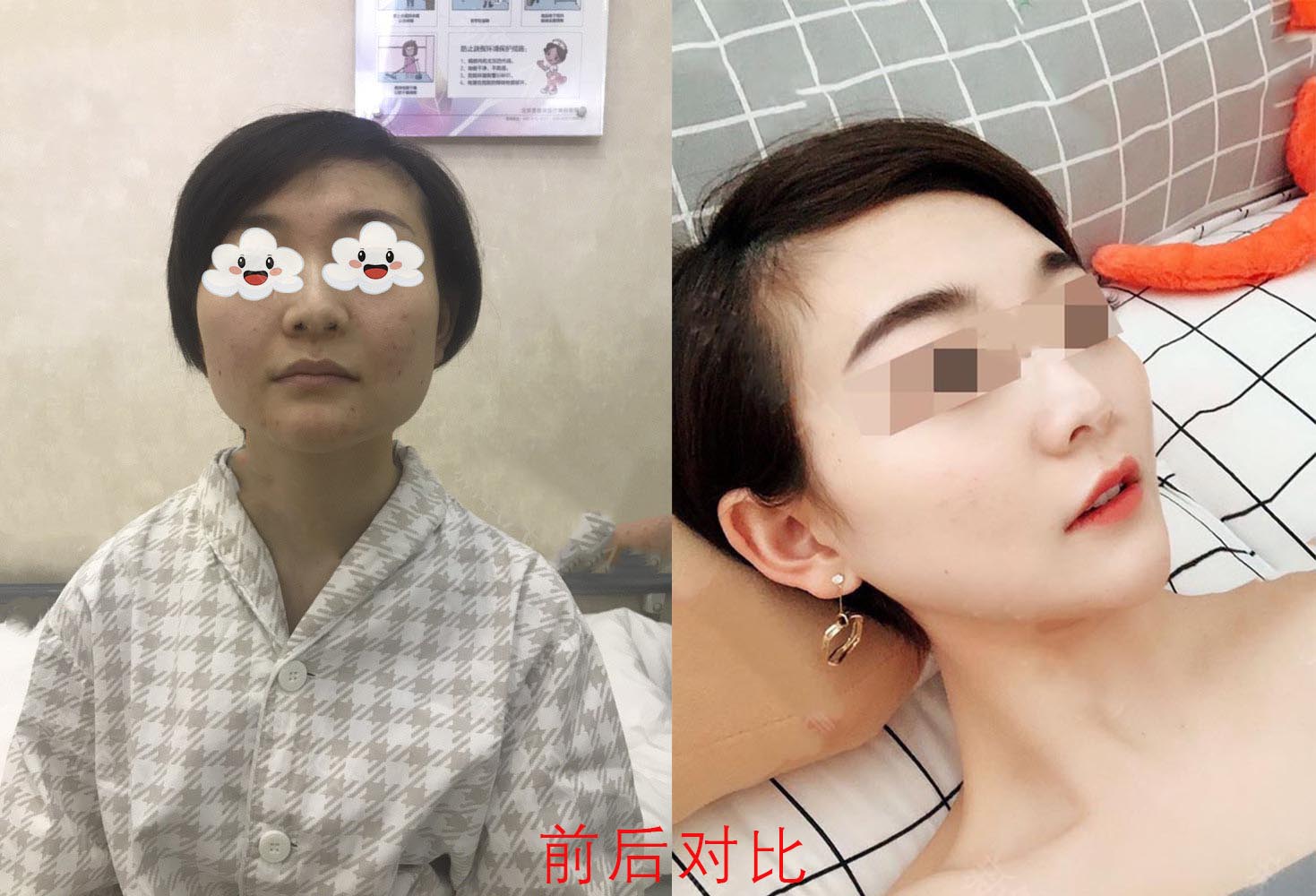 下頜角整形效果前后對(duì)比