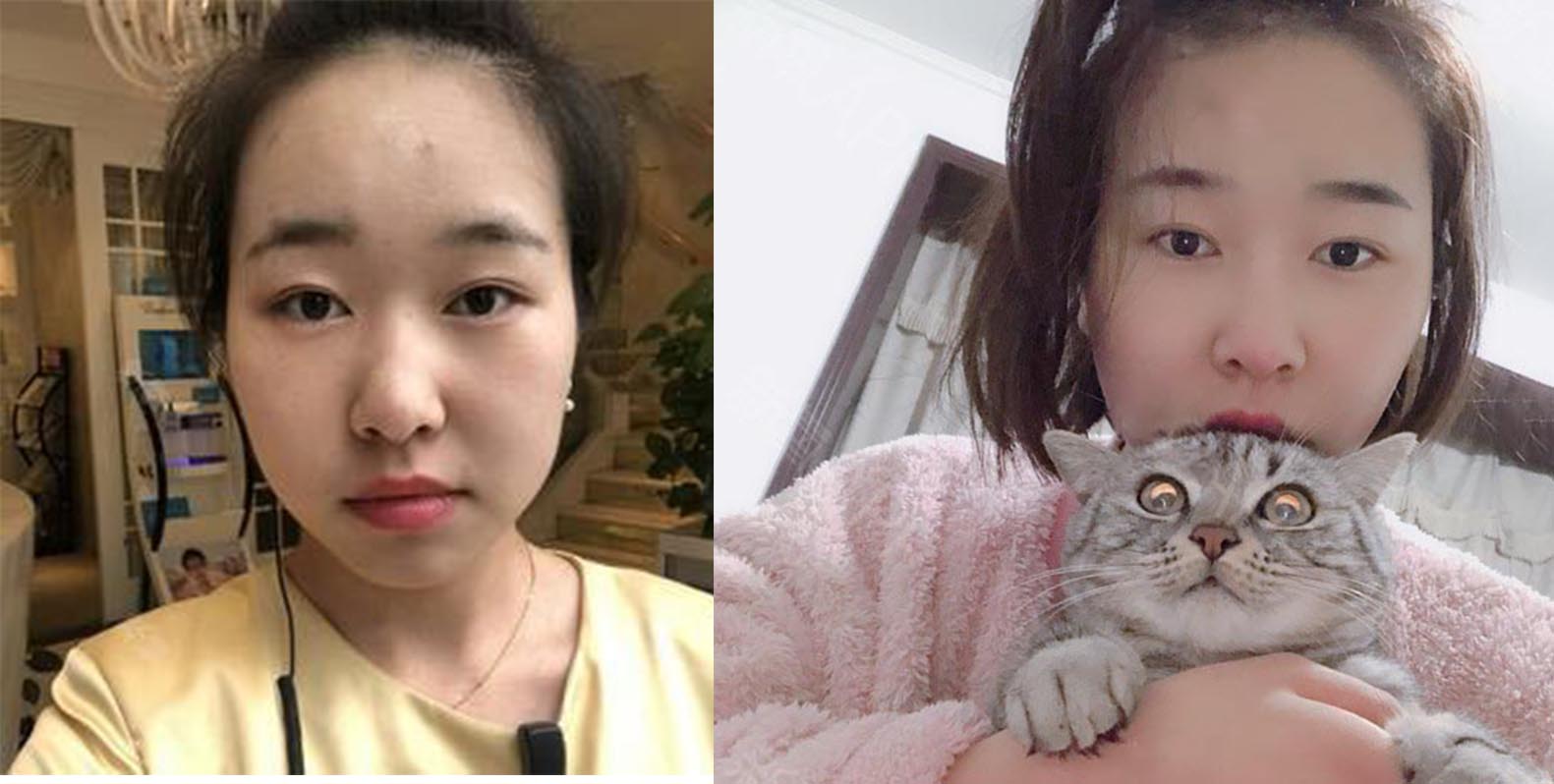 面部填充效果對比圖