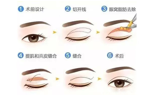 全切雙眼皮跟埋線的區(qū)別是什么？哪個好？