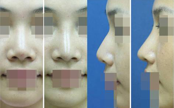 膨體隆鼻前后對比效果