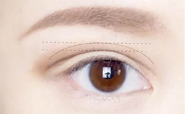雙眼皮手術(shù)費(fèi)用一般是多少?術(shù)前有什么注意事項(xiàng)?