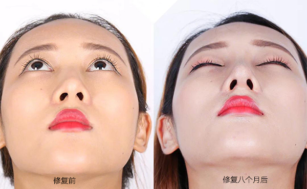 隆鼻手術(shù)失敗怎么辦？修復(fù)費(fèi)用要多少？