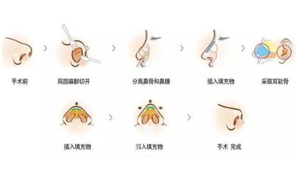 耳軟骨隆鼻效果怎么樣？要多少錢？